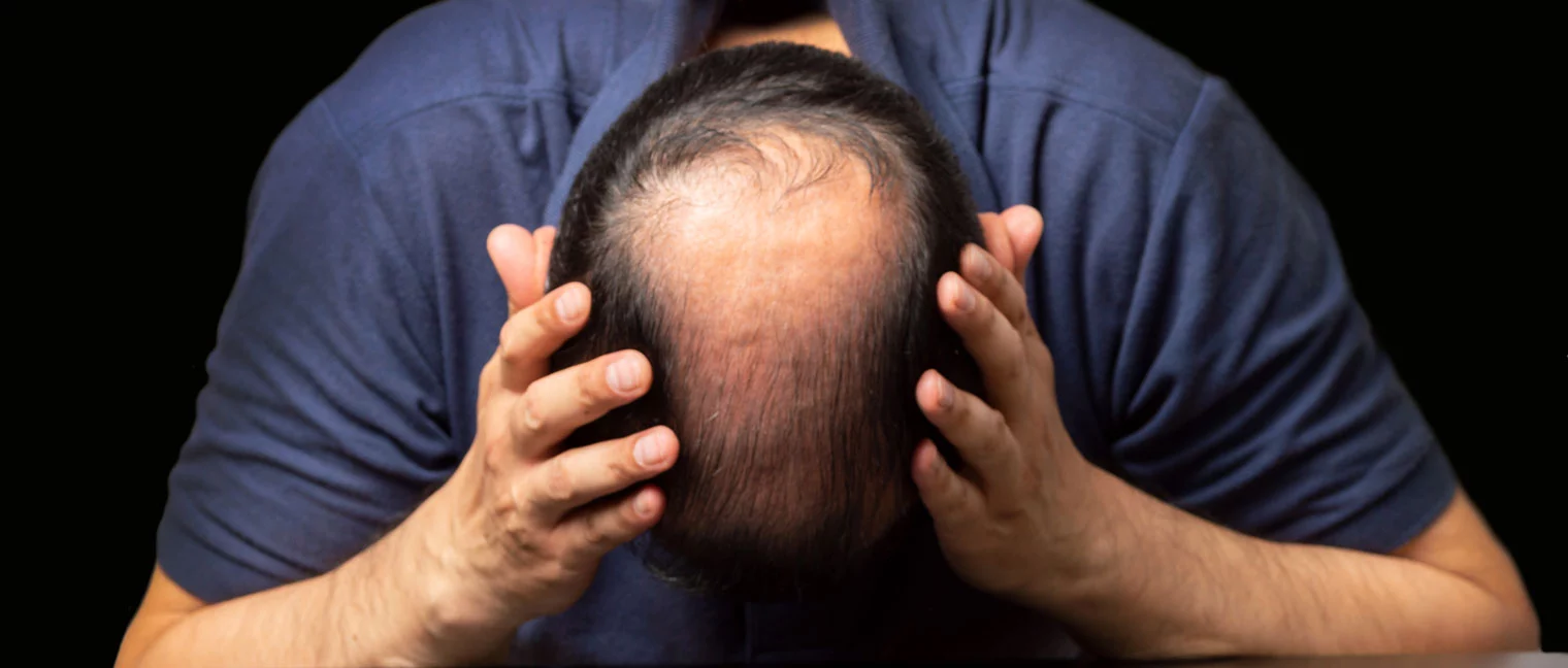 Alcohol And Hair Loss Proven Risks Find Addiction Rehabs Guide