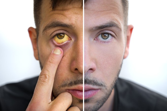 A man shows a jaundiced eye next to a clear eye, to show the symptoms of an alcoholic