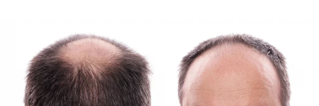 Illegal Drugs That Cause Hair Loss