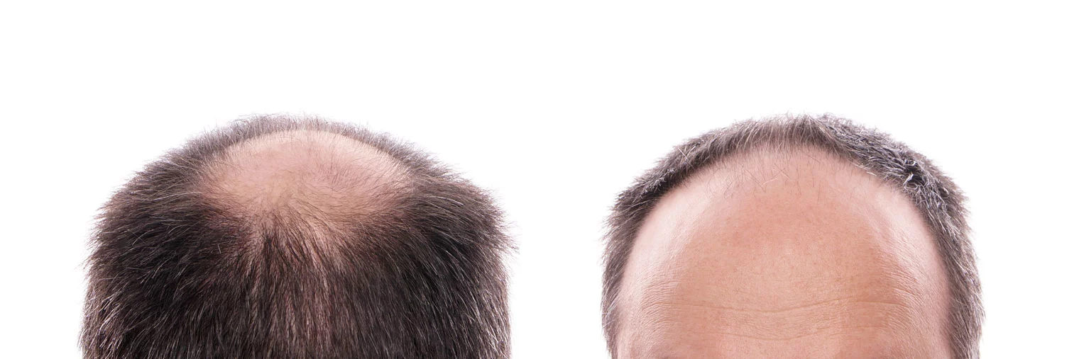 Illegal Drugs That Cause Hair Loss | Proven Drug Resources