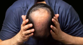 Does Cocaine Cause Hair Loss?
