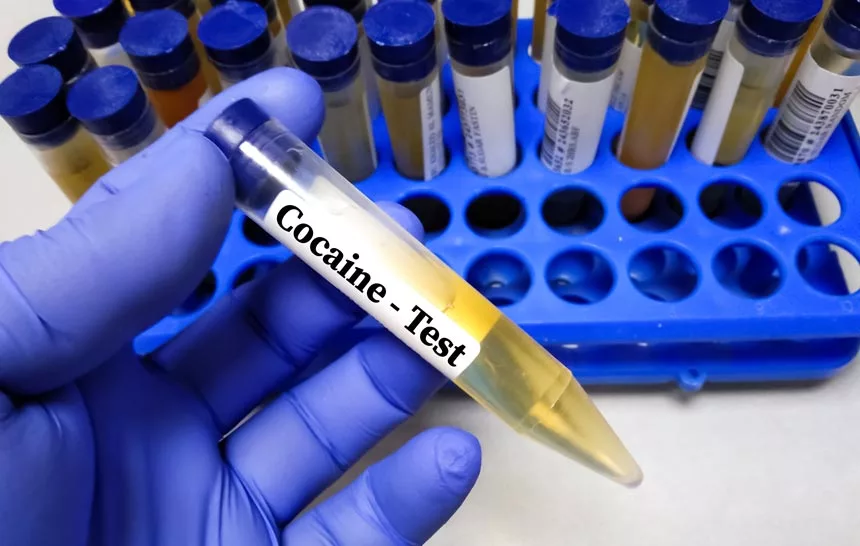 Urine specimen for doping drugs test of cocaine. To detect illegal drugs in human body. 