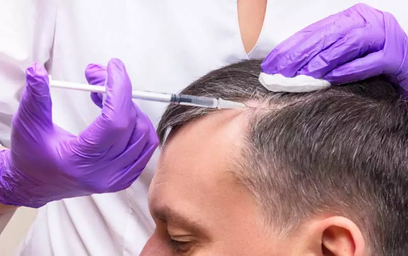 Man taking medical treatment for hair loss